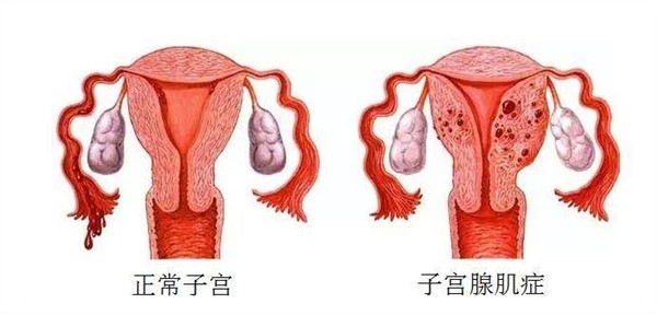 战胜子宫腺肌症梦魇，一场陆续5年的保宫战，在北京卫人中医院宣告胜利
